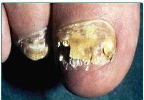 Funal nail infection